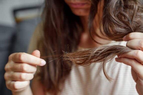 Hair Vitiligo