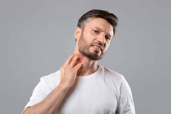 Eczema and atopic dermatitis
