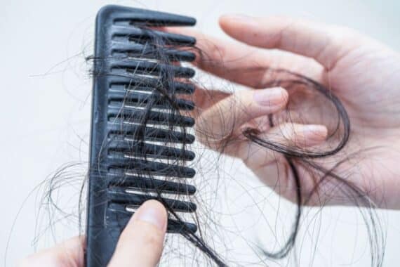 Hair Loss