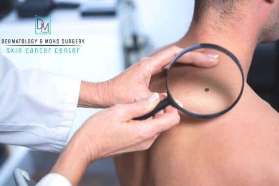 melanoma stages
