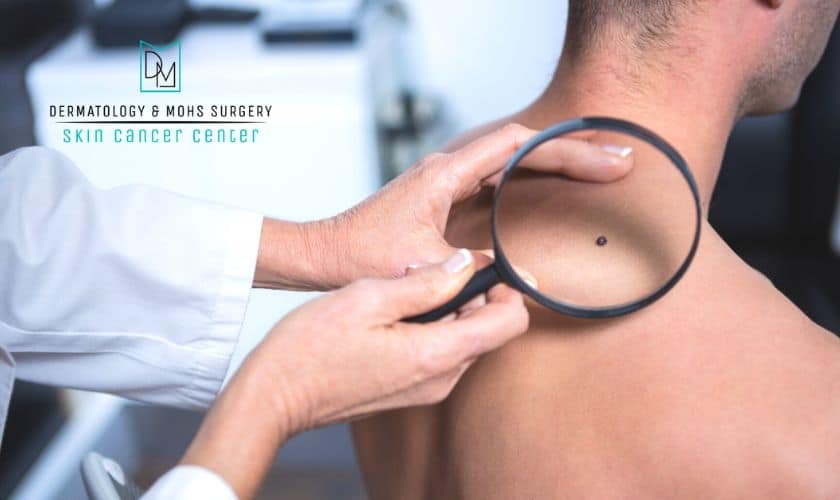 melanoma stages