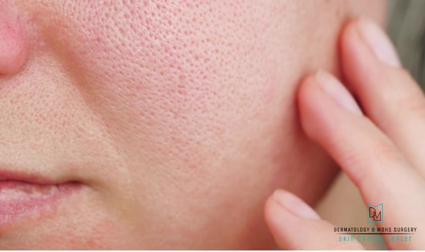 How To Reduce Skin Pore Size Naturally