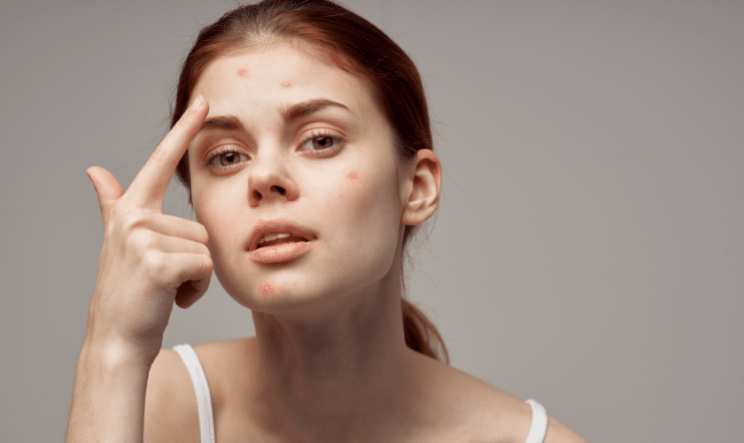 The Ultimate Guide to Acne: Types, Triggers, and Treatments