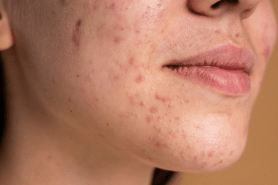 Understanding Acne- Causes, Treatments and Prevention Tips