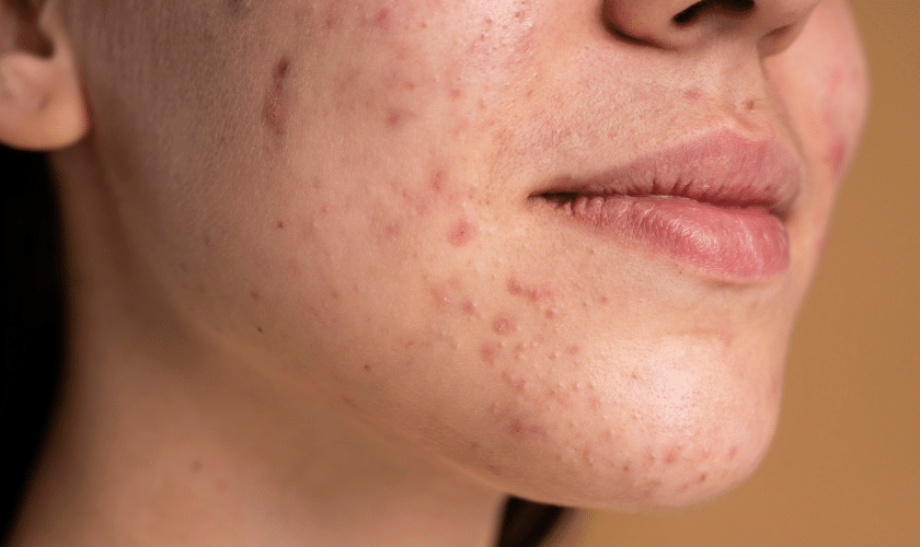 Understanding Acne- Causes, Treatments and Prevention Tips