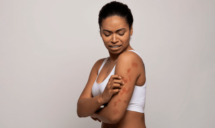 Understanding Eczema- Strategies for Managing and Treating Flare-Ups