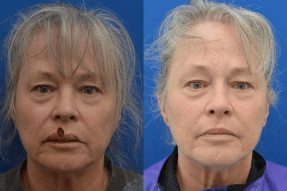 mohs surgery for melanoma a complex approach