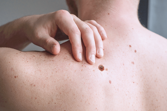 Can melanoma be cured