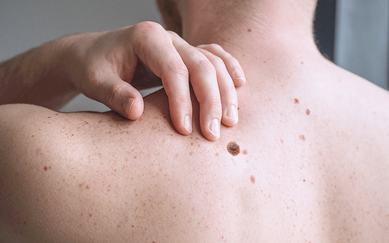 Can melanoma be cured