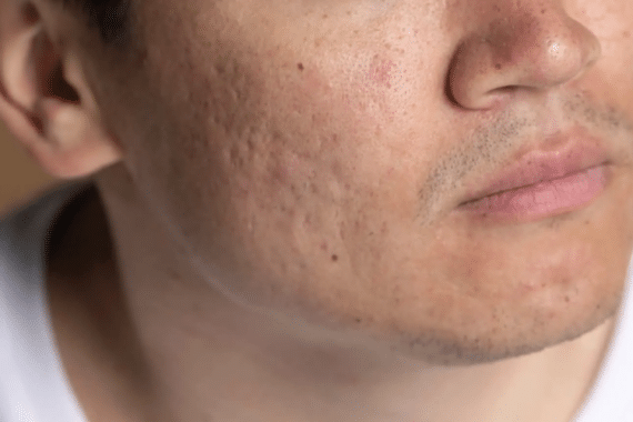What is scar reduction treatment