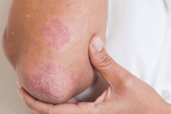 What is the main cause of fungal infection