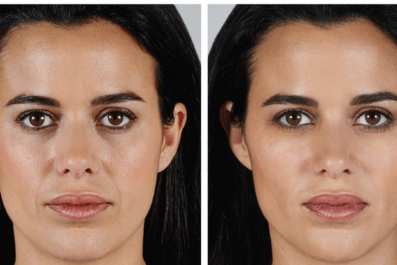 Benefits of Juvederm