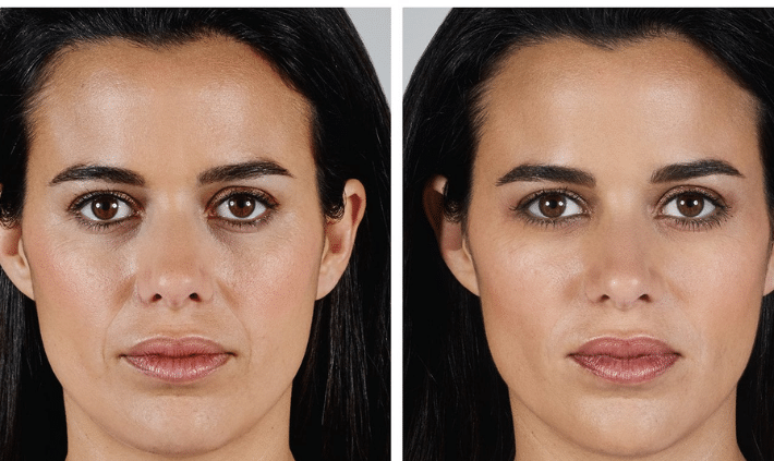 Benefits of Juvederm