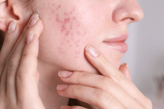 Restore Your Skin with Effective Acne Scar Treatments