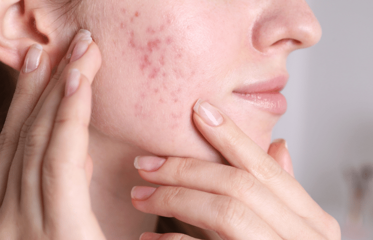 Restore Your Skin with Effective Acne Scar Treatments