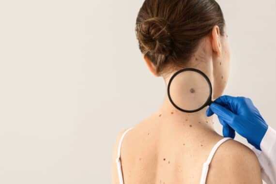 how to protect your skin from melanoma