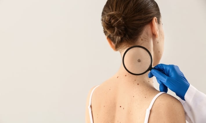 how to protect your skin from melanoma