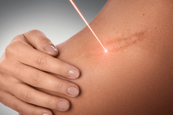 What Is The Best Treatment For Scar Reduction?